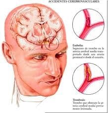 Imagen de accidentes cerebrovasculares. (WEB)