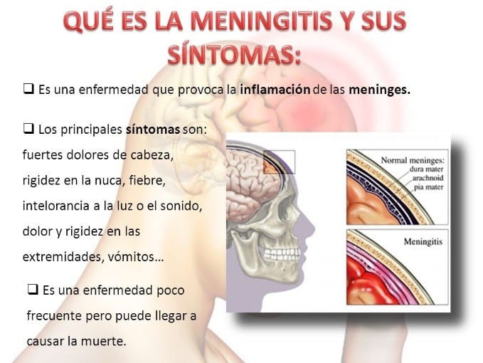 Síntomas de la meningitis.