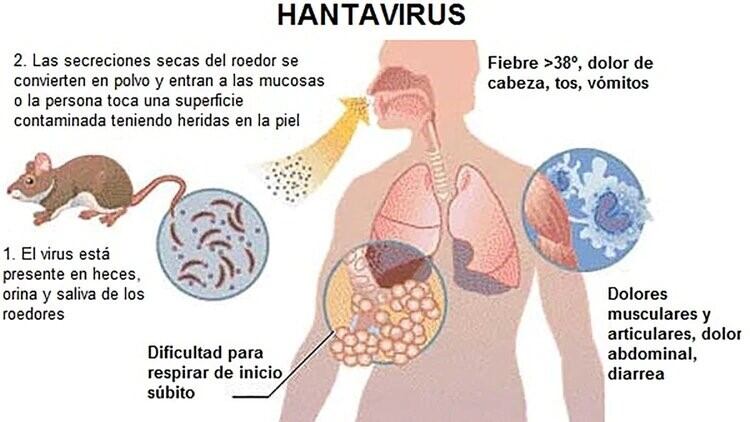 Hantavirus.