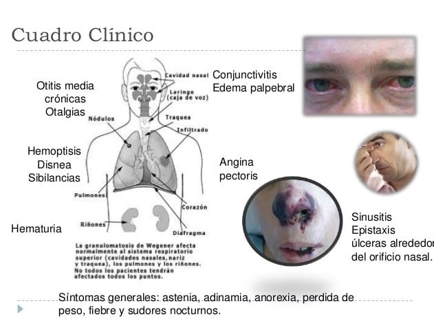 Rranulomatosis de Wegener