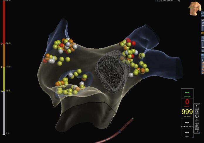 Ablación de fibrilación auricular con mapeo tridimensional en Concepción del Uruguay.