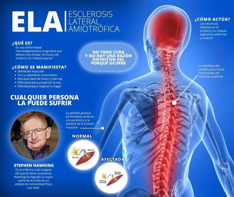 Esclerosis lateral amiotrófica