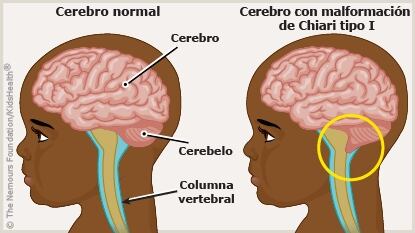 Yonathan, el pequeño correntino de 8 años, necesita operarse de Arnold-Chiari.