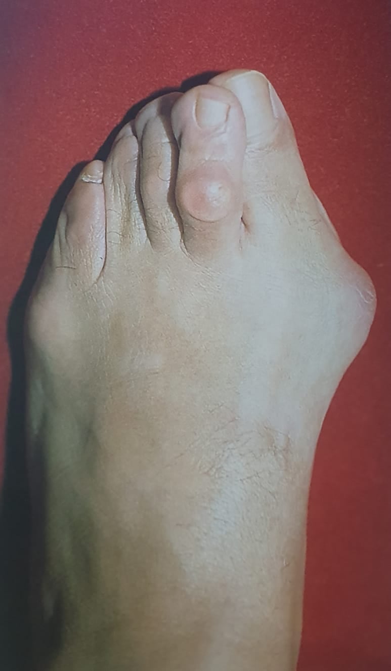 El hallux valgus o juanetes es un problema articular muy común.