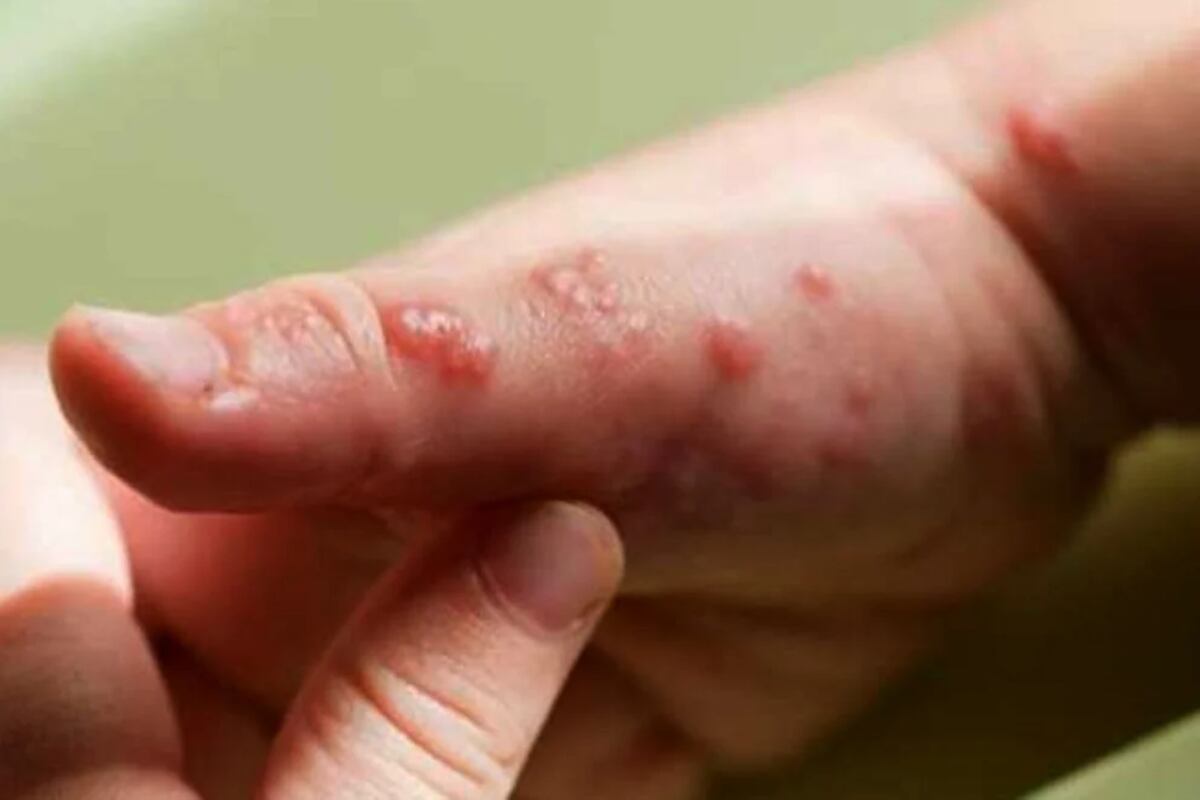 Viruela de mono en Córdoba: dos nuevos contagios, con antecedentes de viaje a Europa