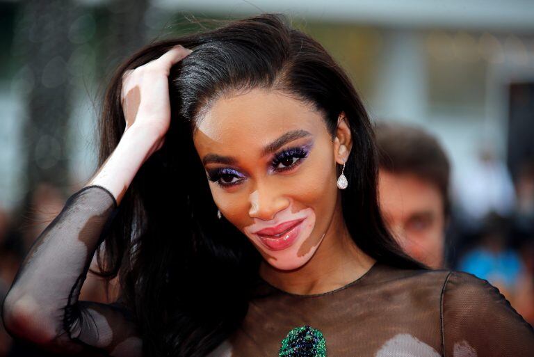 Winnie Harlow. (Foto:REUTERS/Jean-Paul Pelissier)