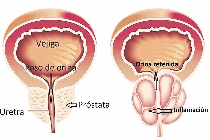 Síntomas en Cáncer de Próstata