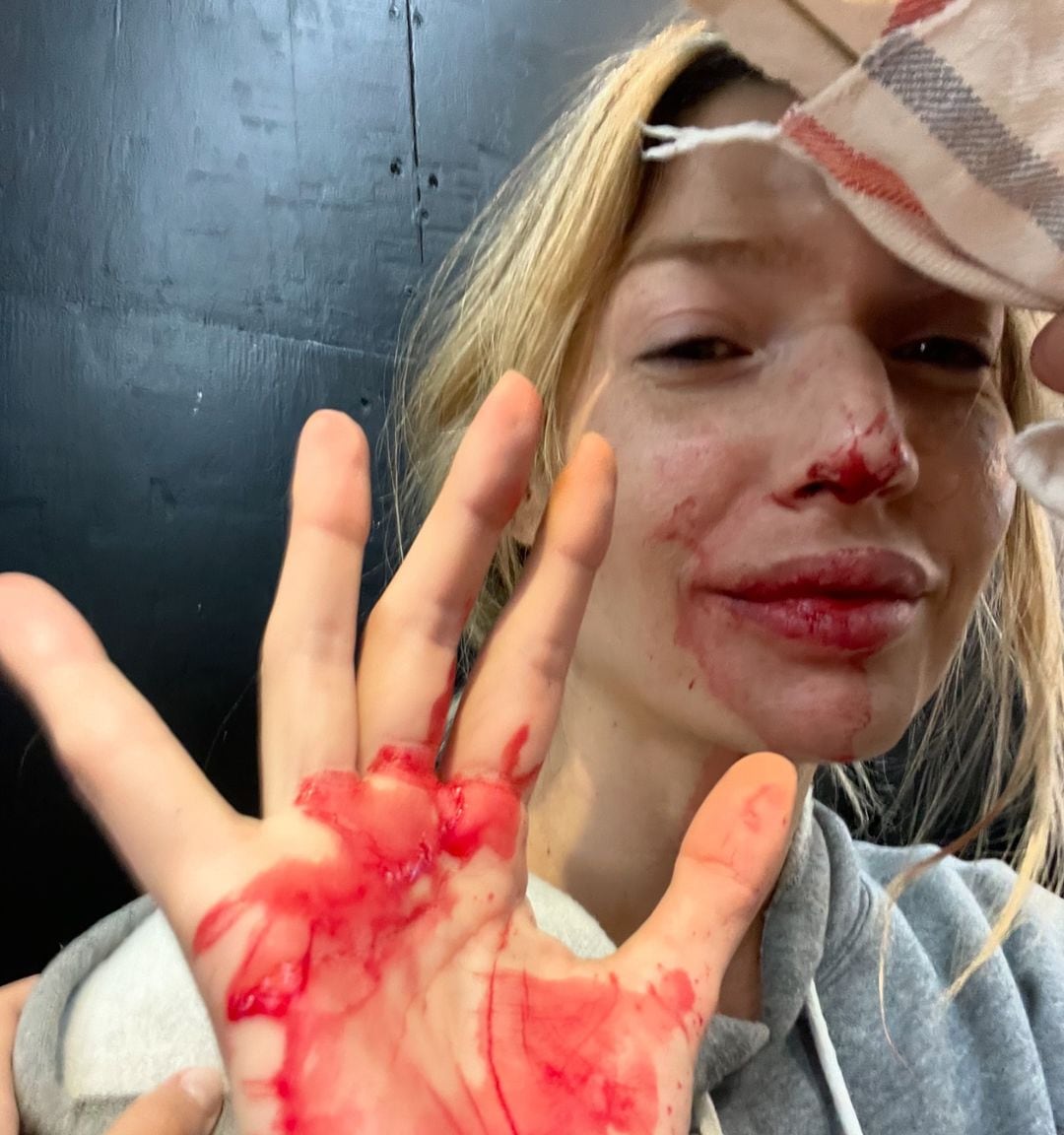 El terrible accidente de Chloé Bello