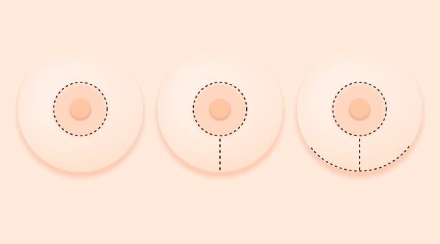 (De izquierda a derecha) Tipos de incisión: circunferencial alrededor de la areola, con extensión vertical y/o con extensión horizontal.