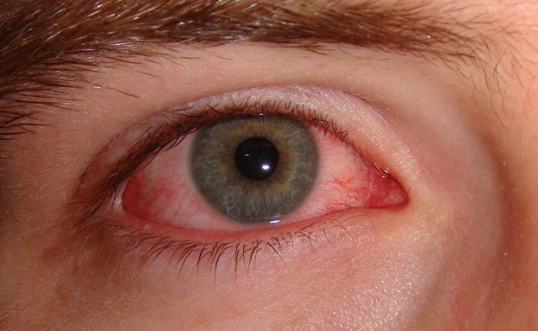 conjuntivitis