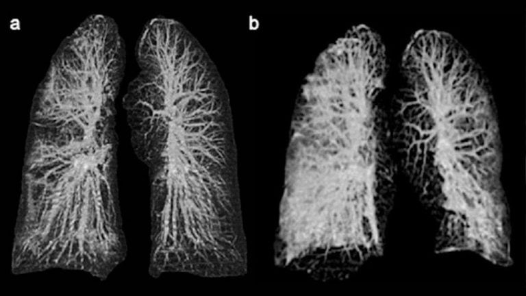 Rápido deterioro pulmonar de los primeros casos de coronavirus en Italia (credito: International Journal of Infectious Diseases).