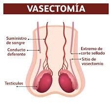 Esos son los conductos que se cortan en una vasectomía.