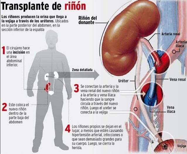 Trasplante de riñón.