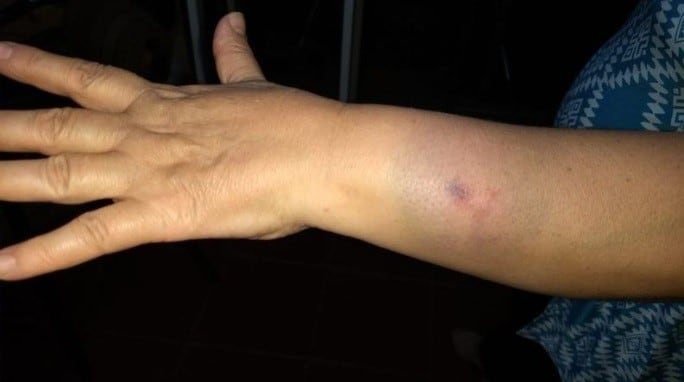 Así quedó el brazo de la médica mendocina mordida por la madre haitiana.