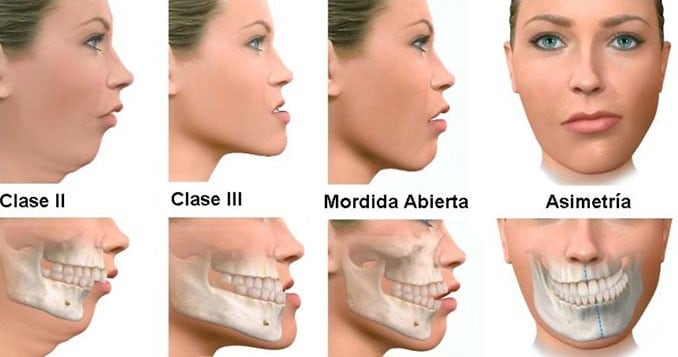 La joven puntana de 26 años que sufría la patología de "prognatismo mandibular clase 3".