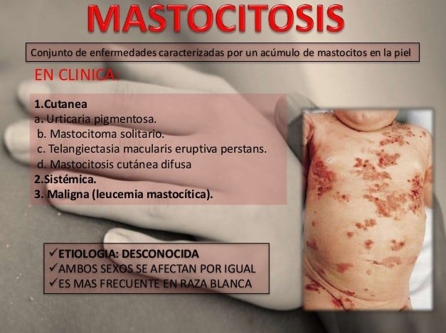 Mastocitosis.