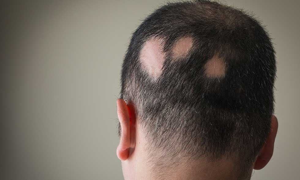 Alopecia areata