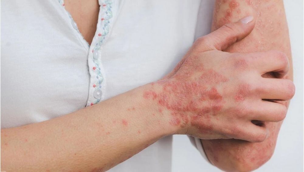 La psoriasis no es contagiosa. 