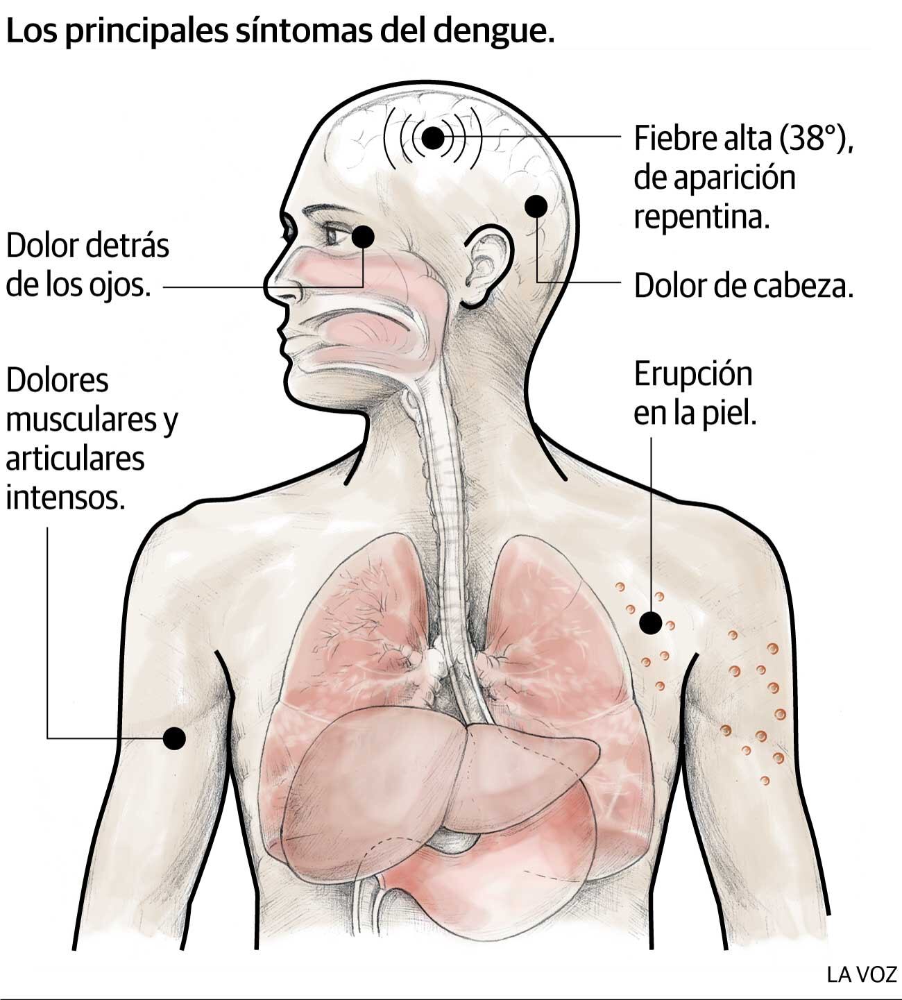 Infografía: Los principales síntomas del dengue