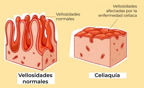 Ilustración del intestino delgado, en su estado sano y cuando se tiene celiaquía.