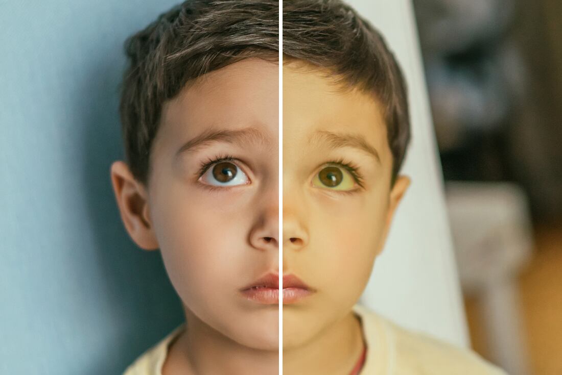 Diferencias entre una piel normal y una piel con síntoma ictericia / Sanatorio Allende