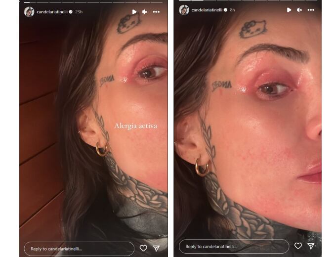 Tinelli sufrió una fuerte alergia en su ojo izquierdo y en sus manos. Foto: Candelaria Tinelli / Instagram