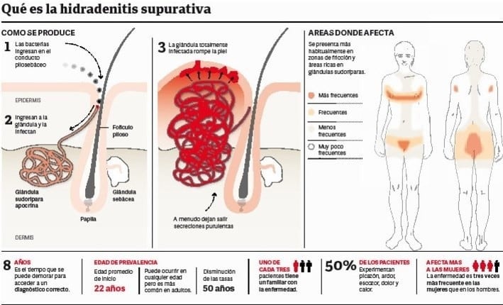 La hidradenitis supurativa es una enfermedad inmunológica y crónica de la piel.