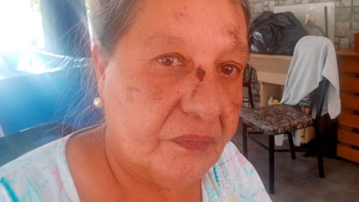 Córdoba: se cayó del colectivo y acusa al chofer por el accidente que pudo costarle la vida