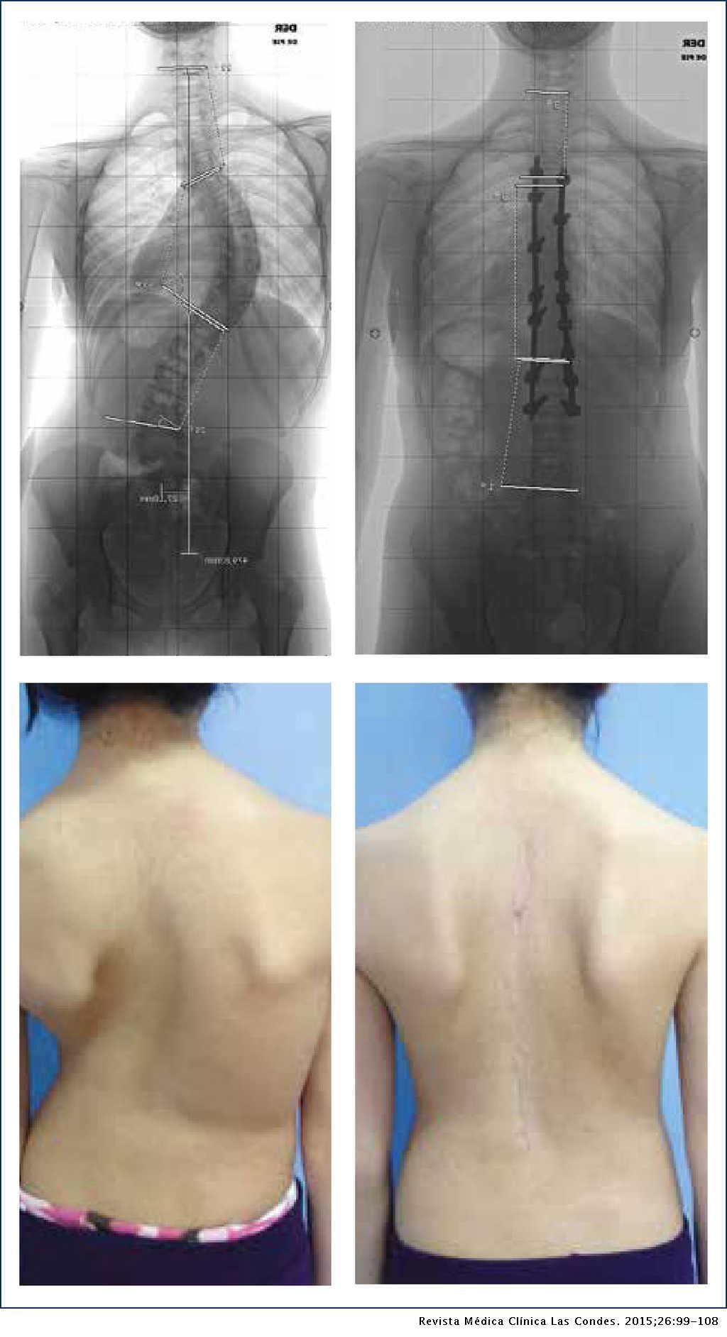 Escoliosis idiopática (imagen ilustrativa).