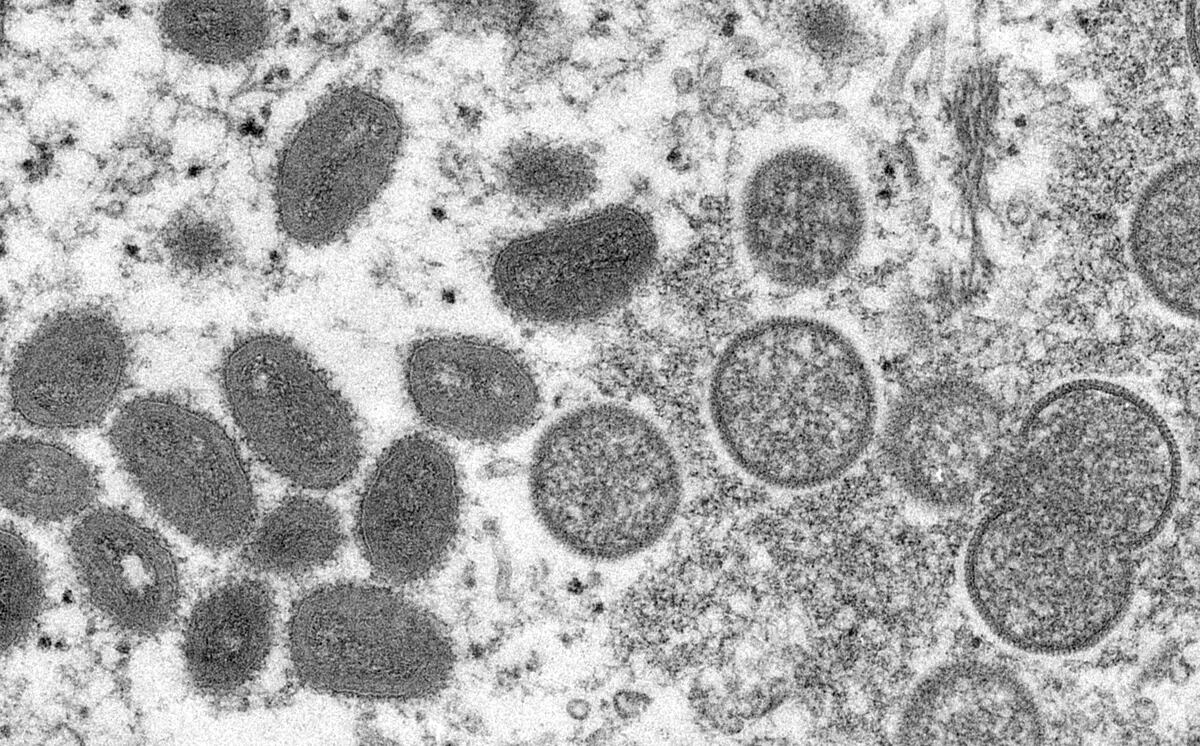 Qué es la “viruela del mono”: cómo es la enfermedad, cuáles son sus sintomas y a qué países llegó