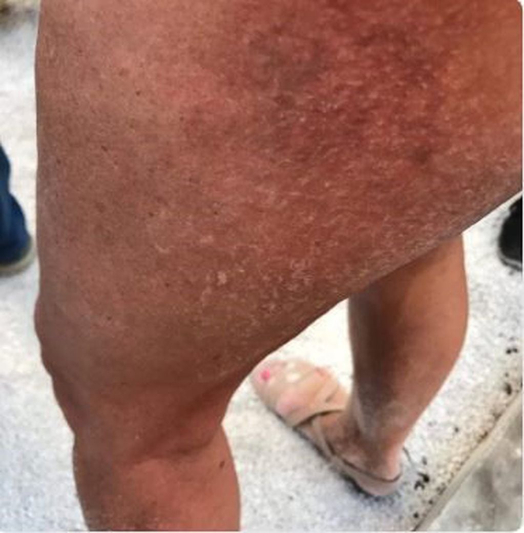 Una mujer muestra sus lesiones después de tirarse por el tobogán de Estepona (Fuente: Twitter)