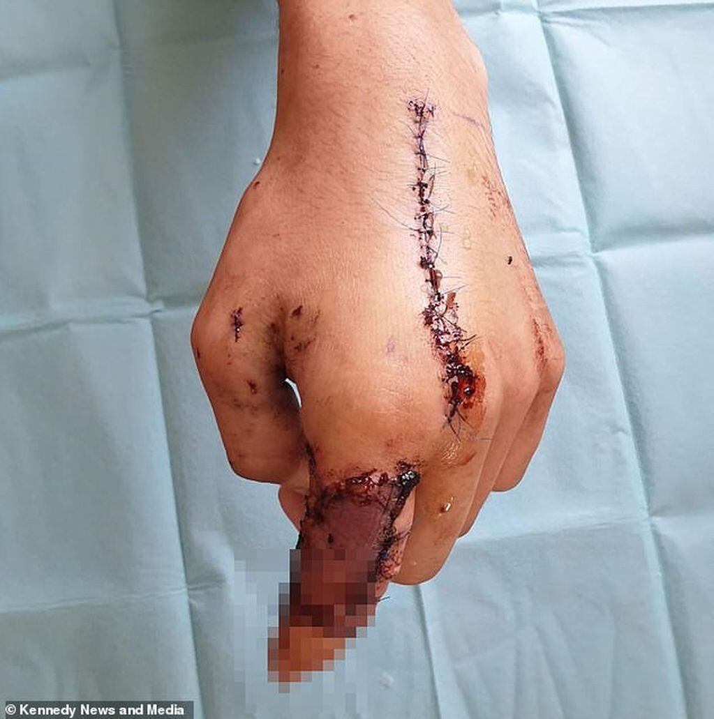 Las heridas del joven luego de que estallara el artefacto (Foto: The Daily Mail)
