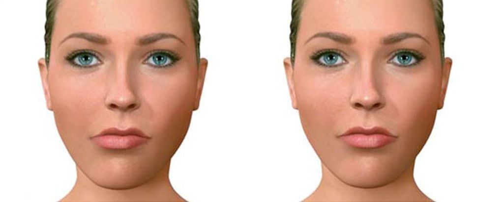 Asimetría facial, imagen ilustrativa (web).