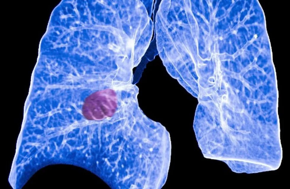 23/05/2017 Cáncer de pulmón.  Una nueva investigación dirigida por científicos de la Unidad de Toxicología del Consejo de Investigación Médica (MRC, por sus siglas en inglés), en Reino Unido, sugiere que, al analizar los niveles de ADN en la sangre, podría mejorarse la detección temprana del cáncer de pulmón.  ESPAÑA EUROPA MADRID SALUD ATS