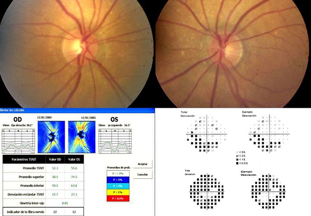Campaña de detección del glaucoma