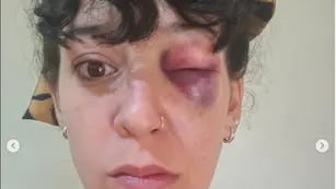 Romina Villacorta denunció ser salvajemente golpeada por su pareja en San Luis