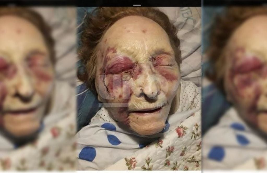 Tiene 93 años y su cuidadora la golpeó brutalmente en el rostro (Uno de Santa Fe)