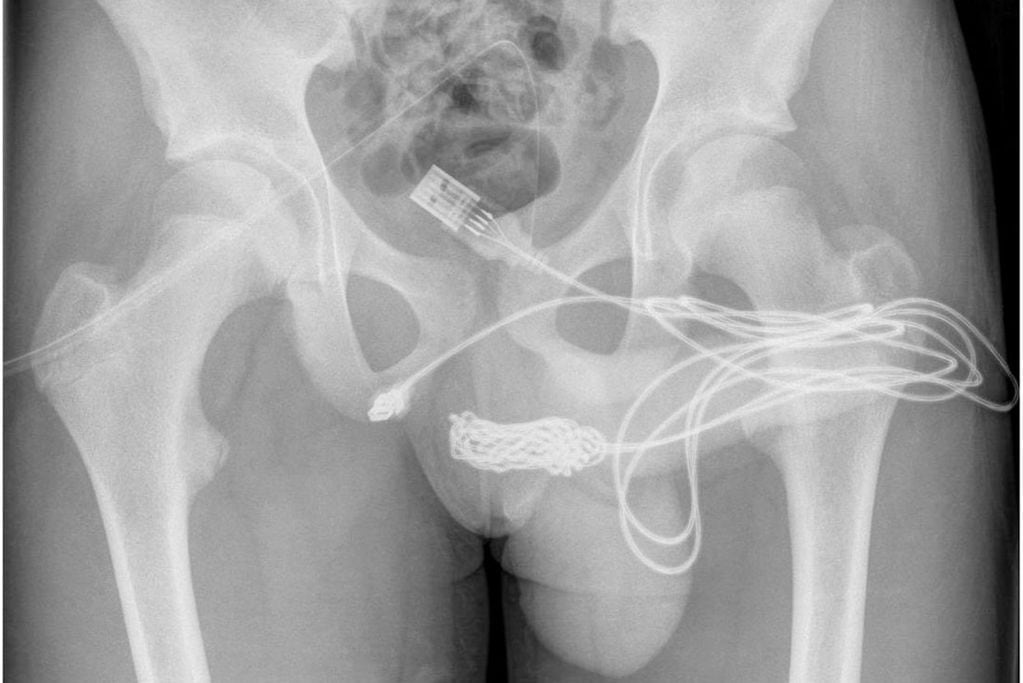 “Autoinserción uretral de un cable USB". Al joven tuvieron que practicarle una cirugía complicada para retirar el cable. Foto: Urology Case Reports.