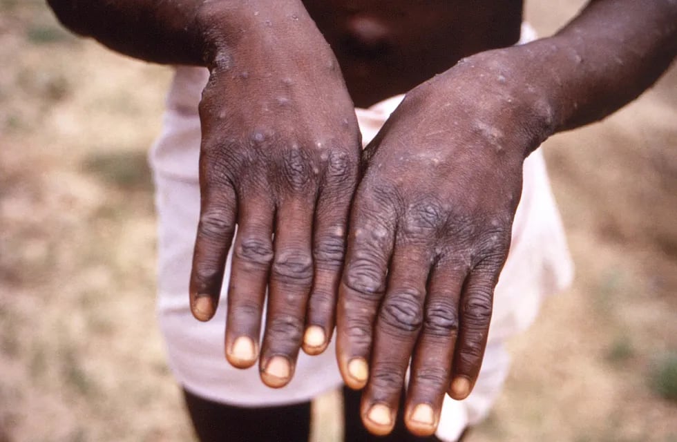 Viruela del mono. Foto: Brian W.J. Mahy / Centers for Disease Control and Prevention / AFP.
