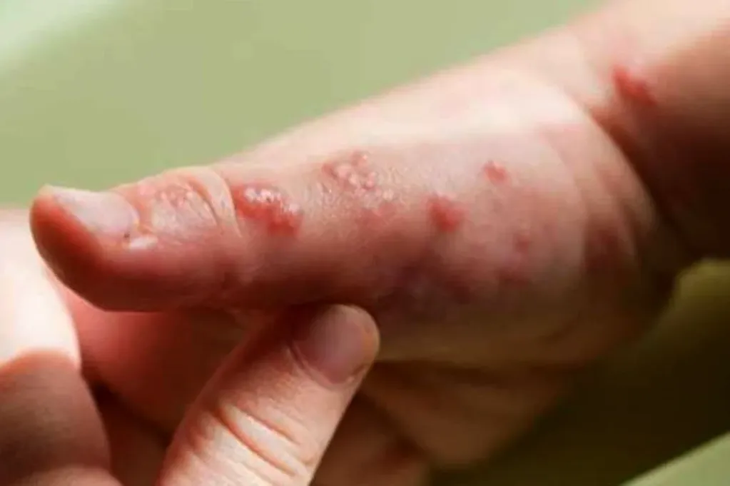 Los síntomas de la viruela del mono se manifiestan en manos, torso, cara y genitales. Foto: Web