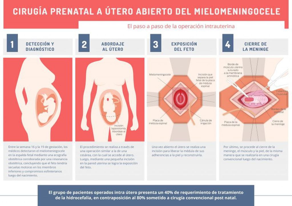 Operación a útero abierto. (Fuente: Hospital Italiano).