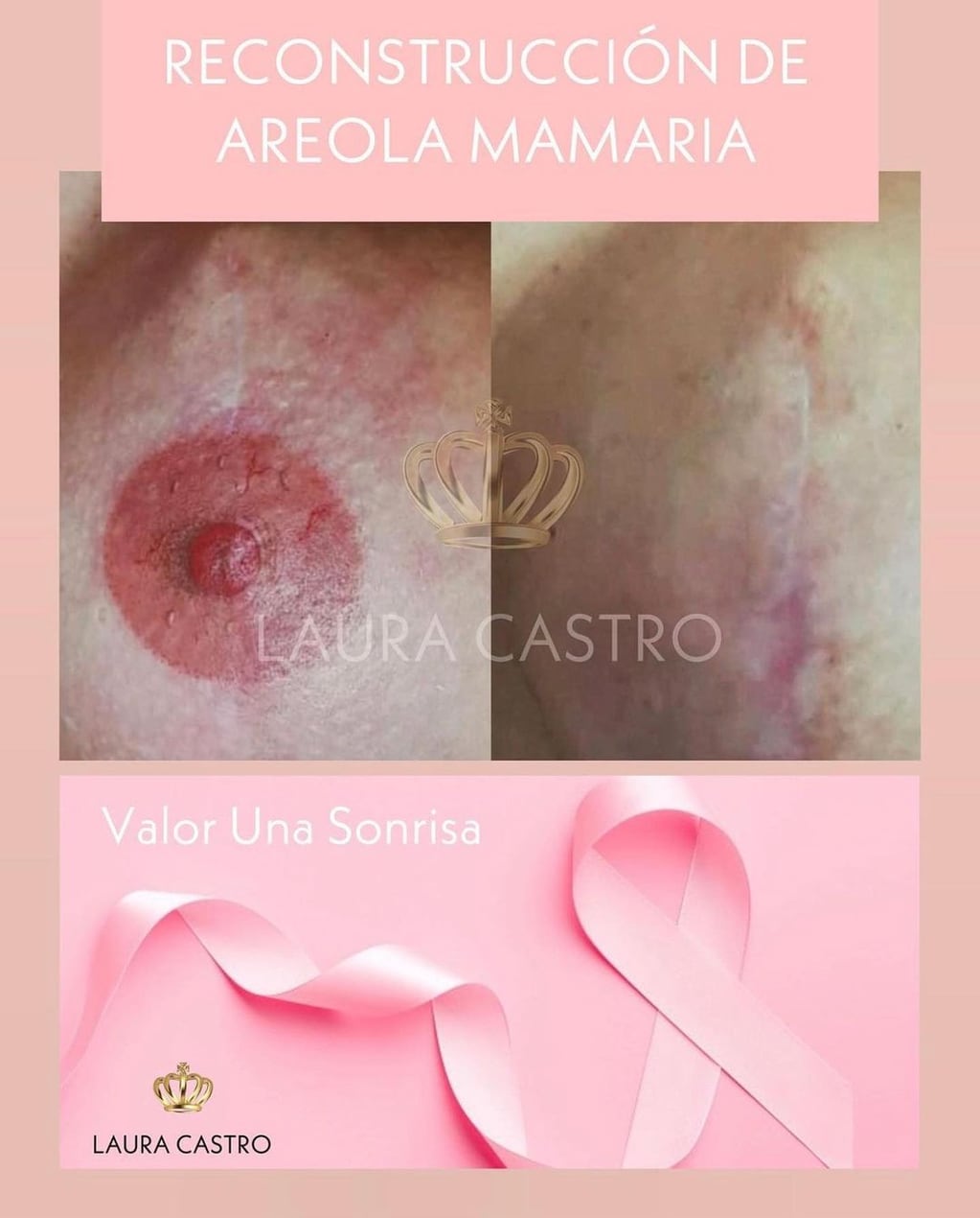 Reconstrucción de areola mamaria gratuita para las mujeres que tuvieron cáncer de mama.